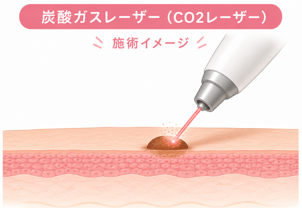炭酸ガスレーザーによるほくろ除去の施術イメージ