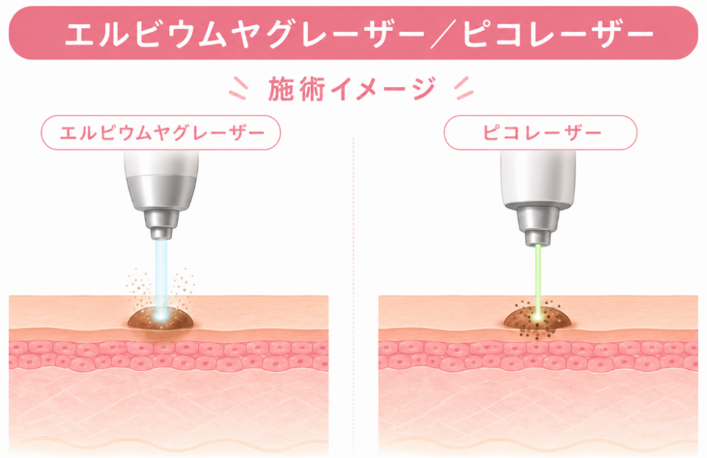 ルビウムヤグレーザの施術イメージ
