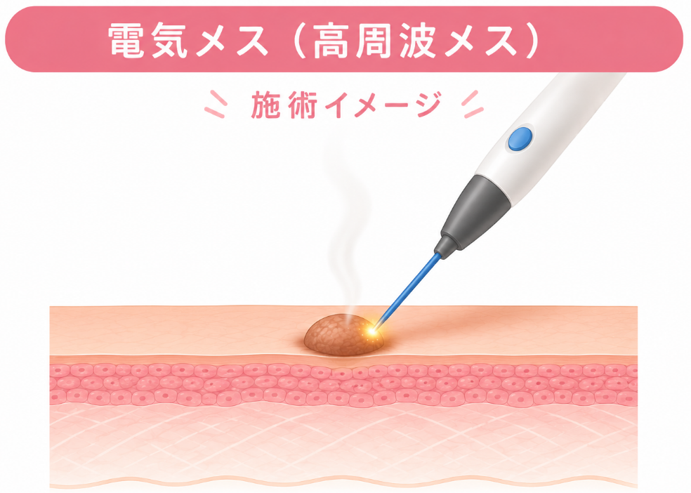 電気メス（高周波メス）によるほくろ除去の施術イメージ