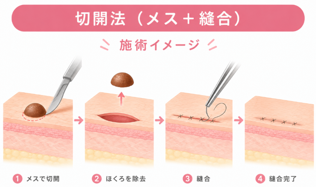 切開法（メス＋縫合）の施術イメージ